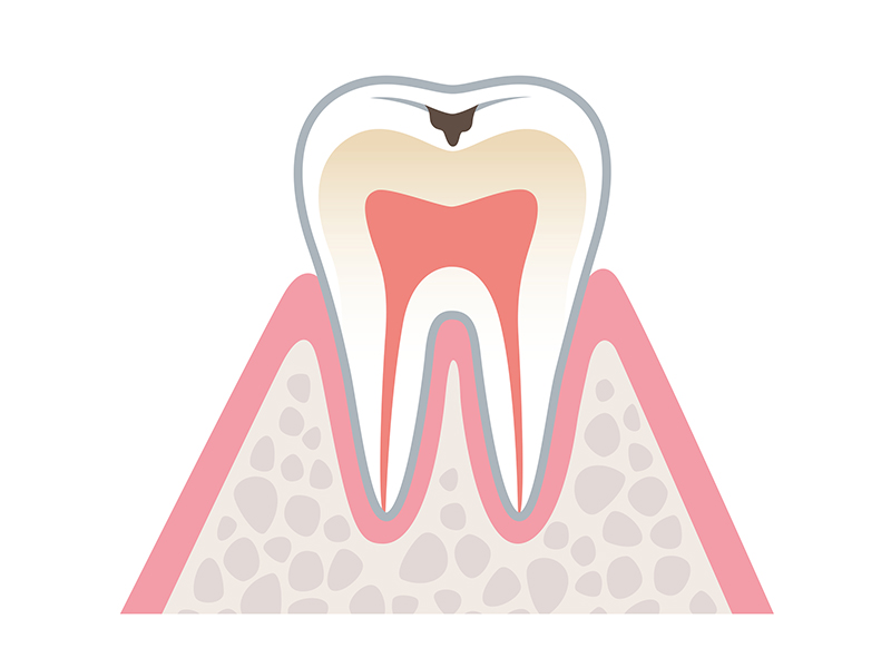 エナメル質の初期むし歯（C1）