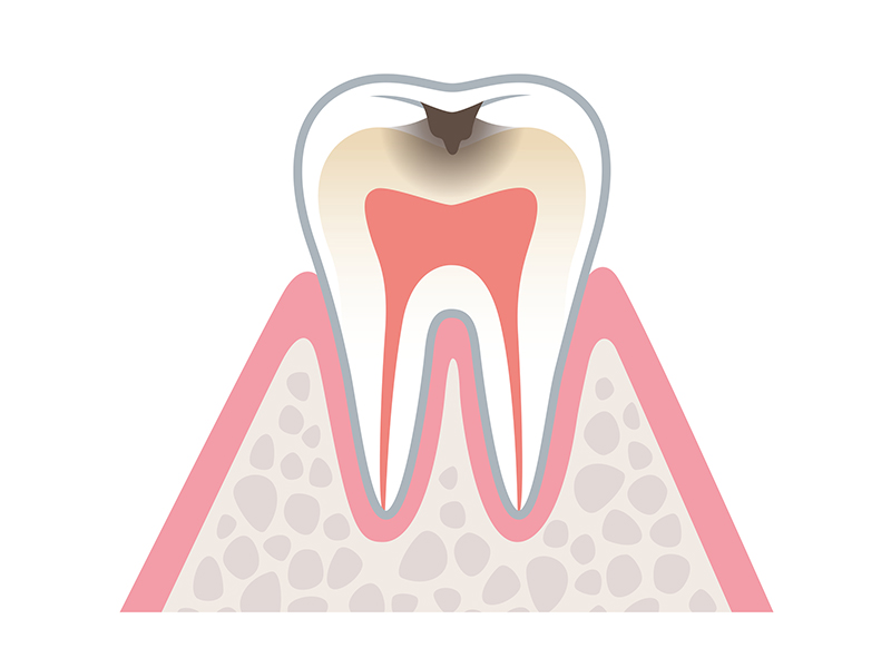 象牙質に達した中等度むし歯（C2）