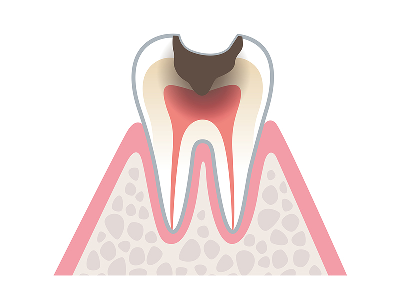 歯髄に達した重度むし歯（C3）