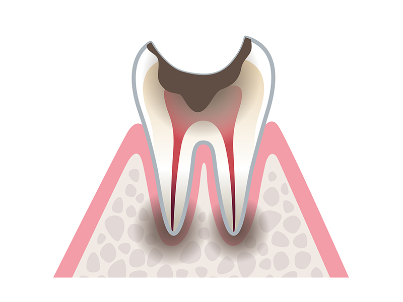 残根状態の末期むし歯（C4）