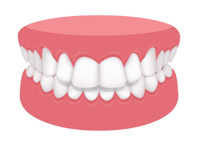 上顎前突（出っ歯）