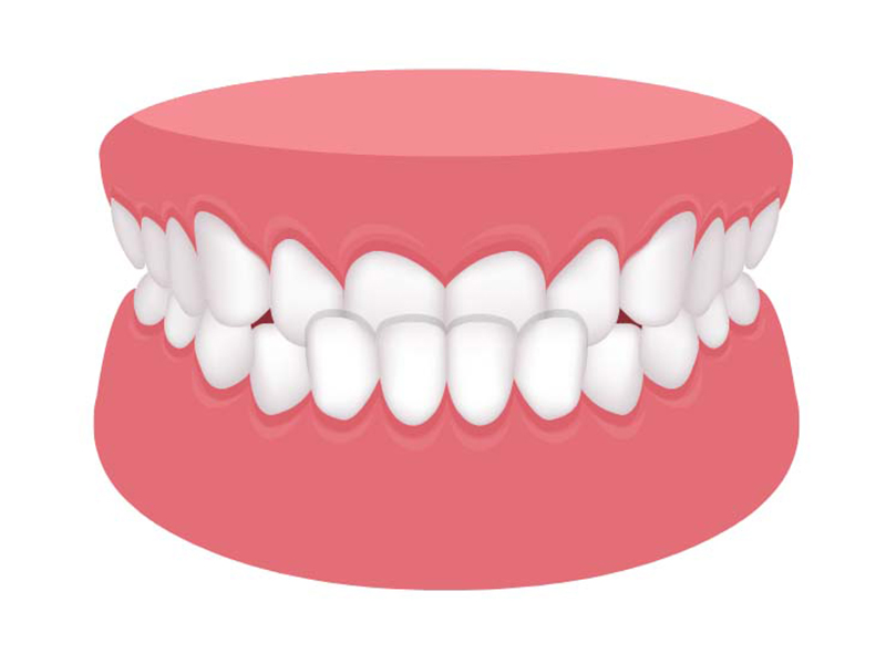 反対咬合（受け口）