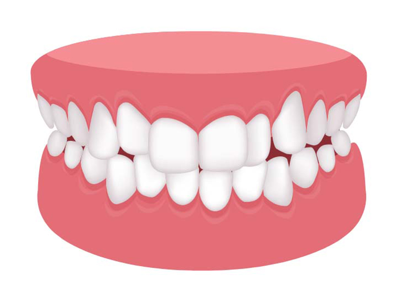 叢生（八重歯・乱ぐい歯）
