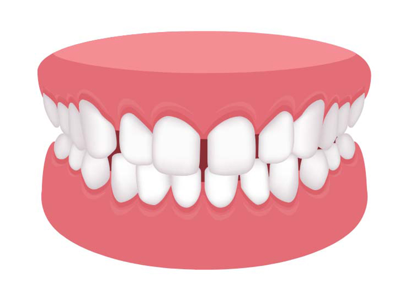 正中離間（すきっ歯）