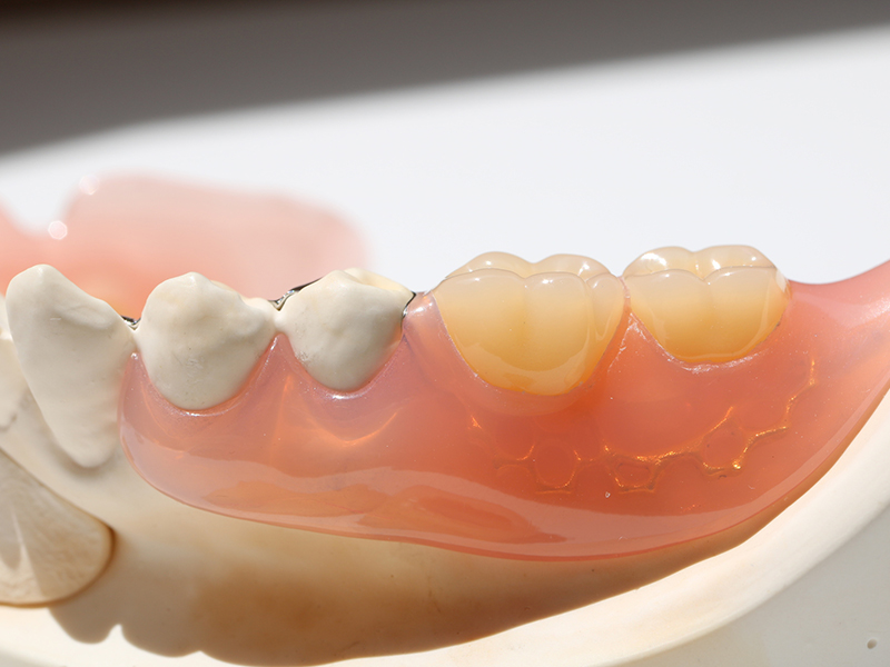 ノンクラスプ義歯