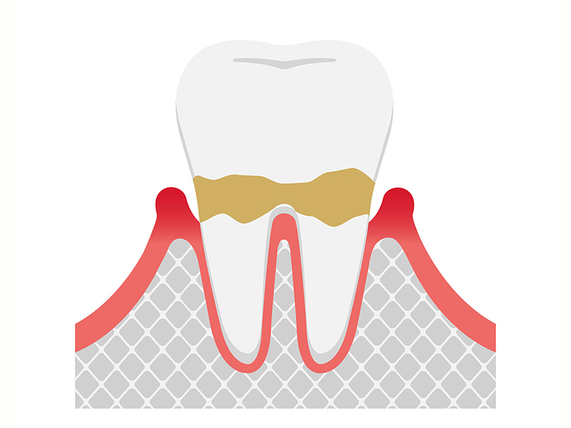 軽度歯周炎